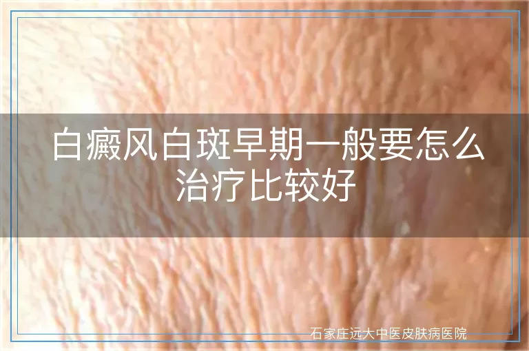 白癜风白斑早期一般要怎么治疗比较好