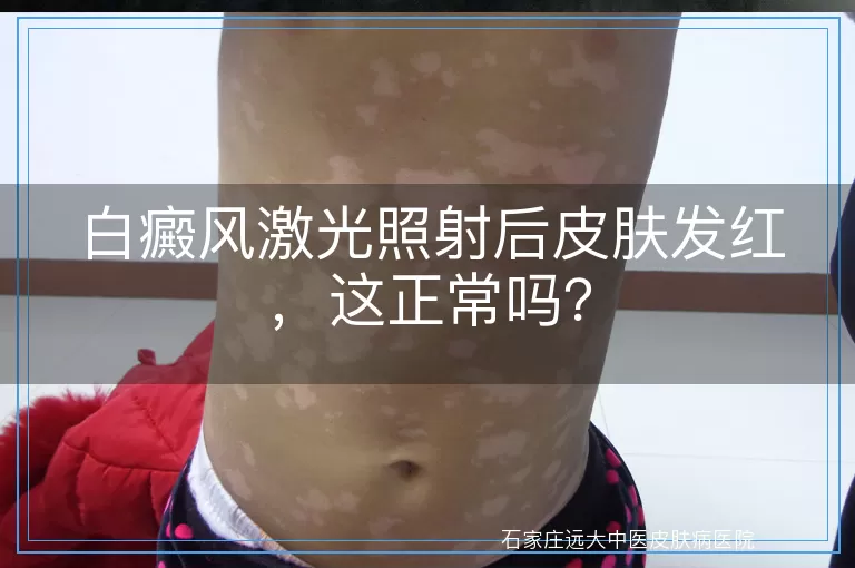 白癜风激光照射后皮肤发红，这正常吗？