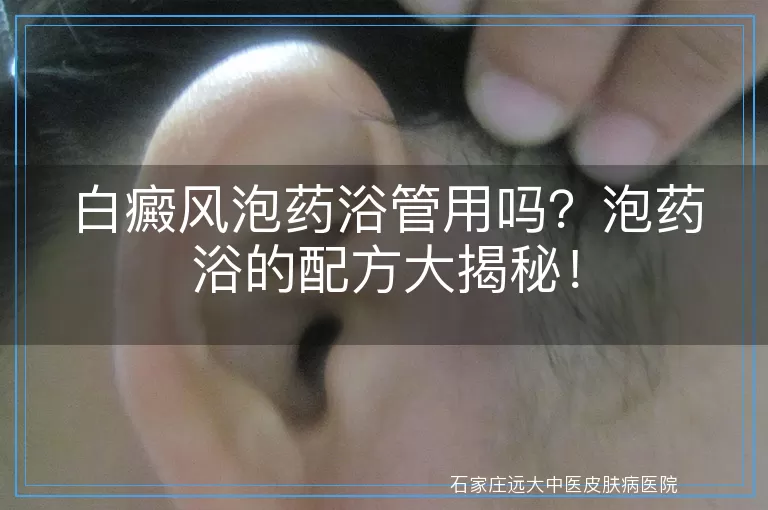 白癜风泡药浴管用吗？泡药浴的配方大揭秘！