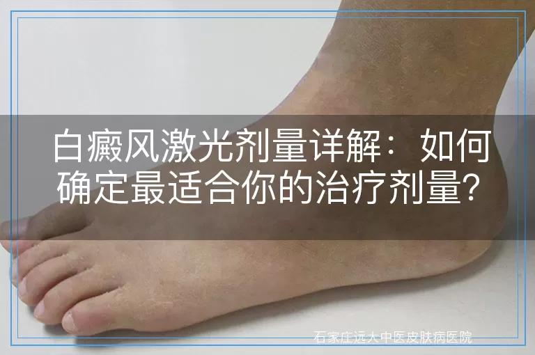 白癜风激光剂量详解：如何确定最适合你的治疗剂量？