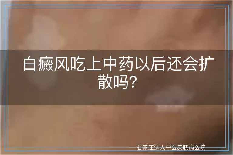 白癜风吃上中药以后还会扩散吗？