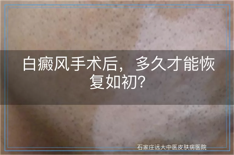 白癜风手术后，多久才能恢复如初？