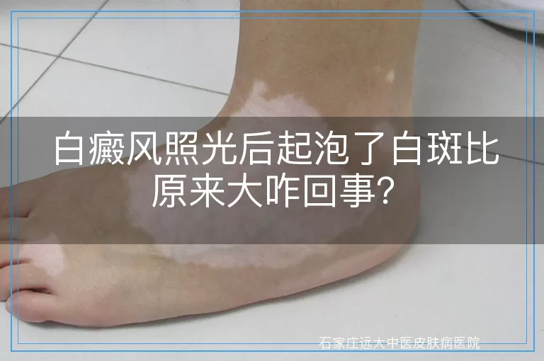白癜风照光后起泡了白斑比原来大咋回事?
