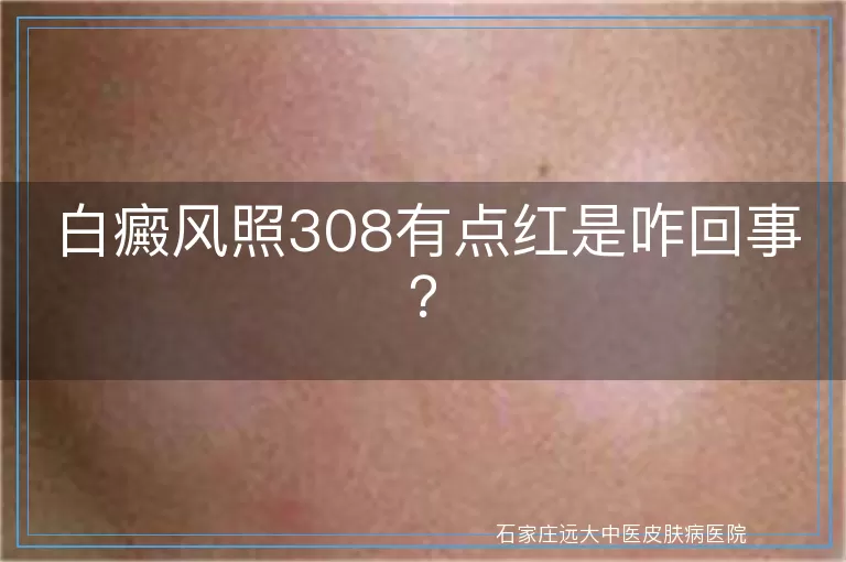 白癜风照308有点红是咋回事?