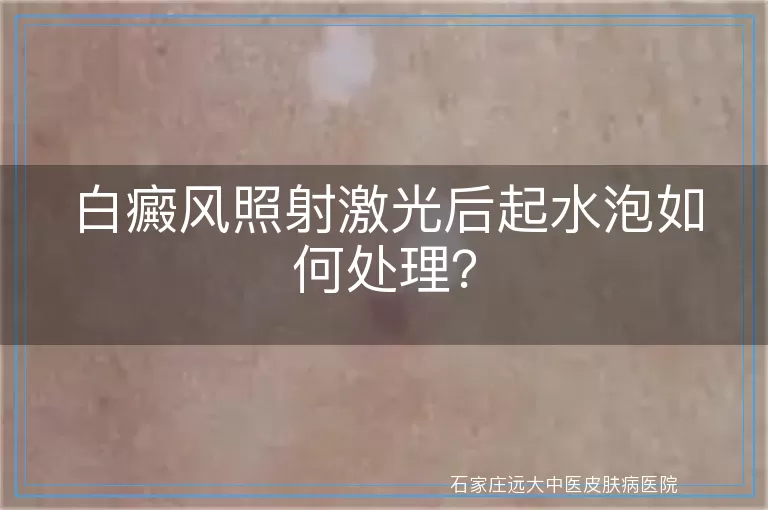 白癜风照射激光后起水泡如何处理?