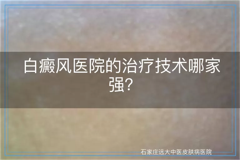 白癜风医院的治疗技术哪家强？