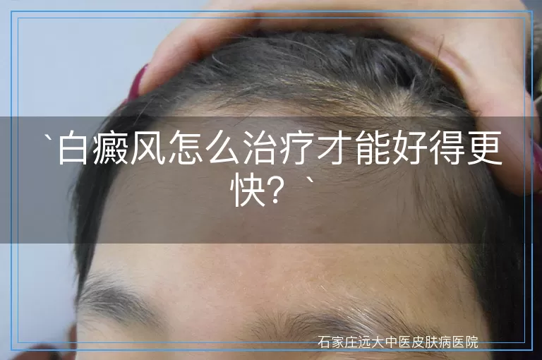 白癜风怎么治疗才能好得更快？