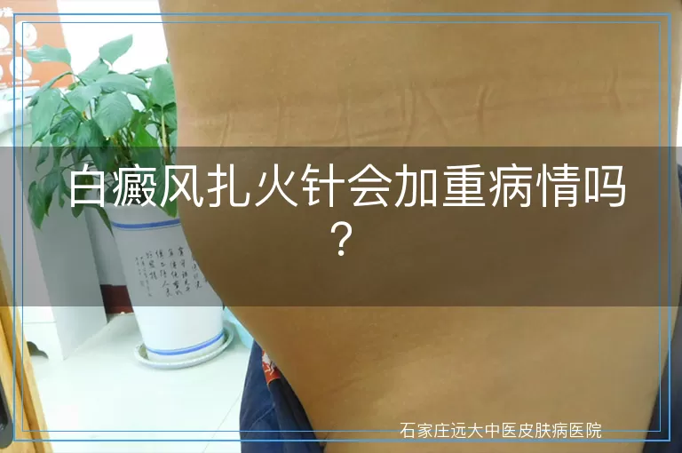 白癜风扎火针会加重病情吗？