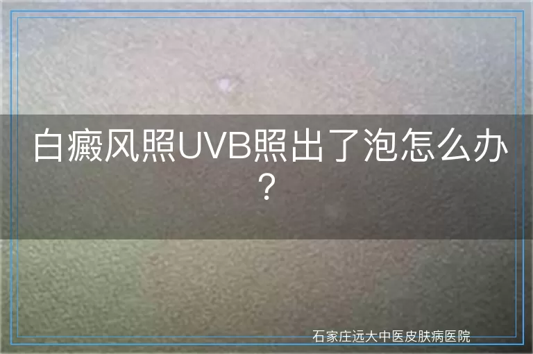 白癜风照UVB照出了泡怎么办？