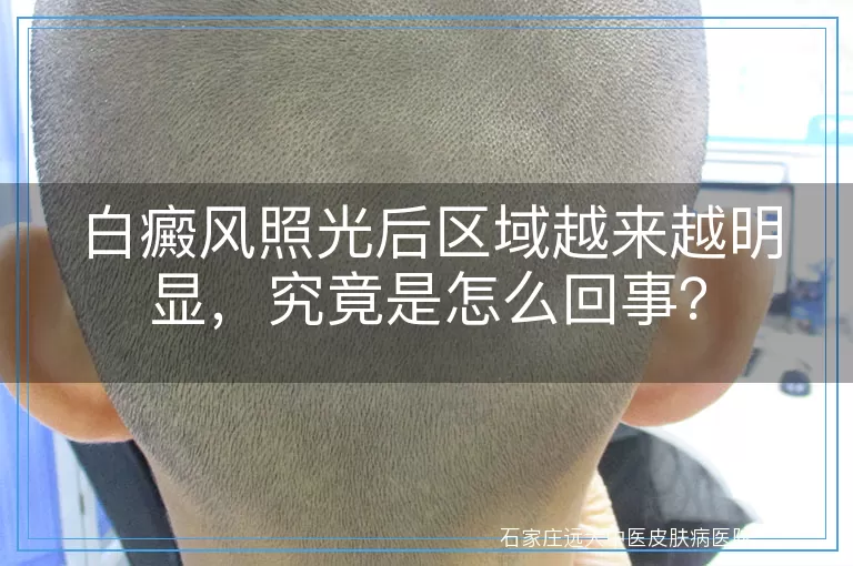 白癜风照光后区域越来越明显,究竟是怎么回事?