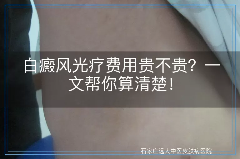 白癜风光疗费用贵不贵？一文帮你算清楚！