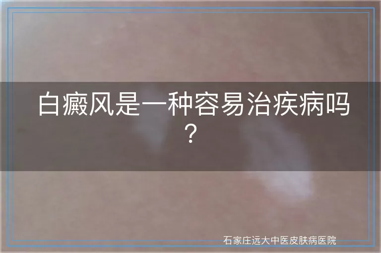 白癜风是一种容易治疾病吗？