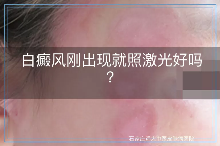 白癜风刚出现就照激光好吗？
