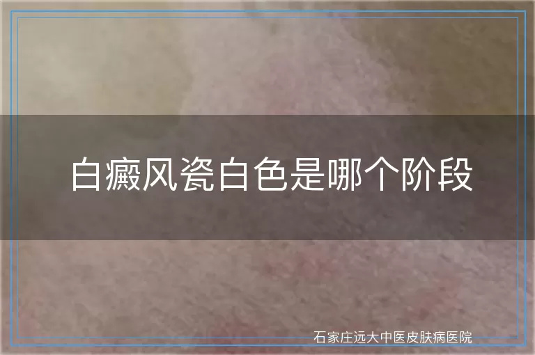 白癜风瓷白色是哪个阶段