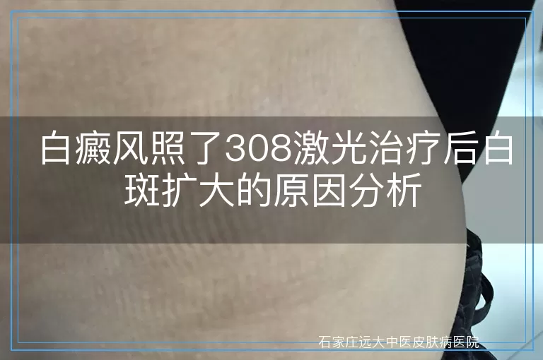 白癜风照了308激光治疗后白斑扩大的原因分析