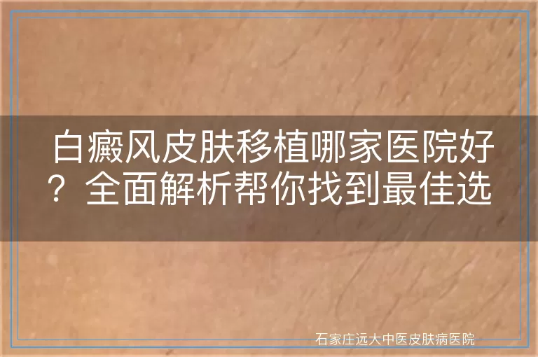 白癜风皮肤移植哪家医院好？全面解析帮你找到最佳选择！