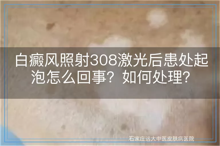 白癜风照射308激光后患处起泡怎么回事?如何处理?