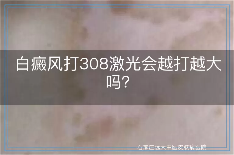 白癜风打308激光会越打越大吗？