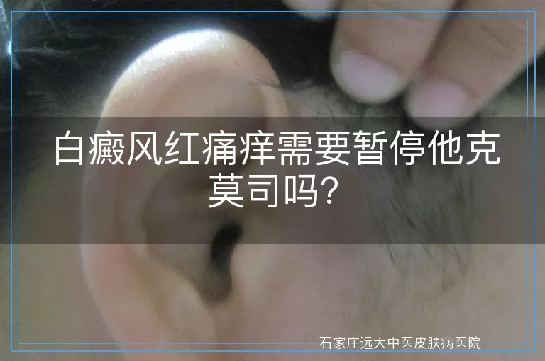 白癜风红痛痒需要暂停他克莫司吗？