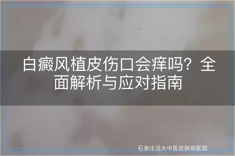白癜风植皮伤口会痒吗?全面解析与应对指南