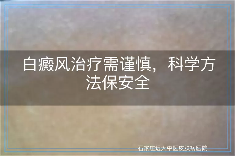 白癜风治疗需谨慎，科学方法保安全