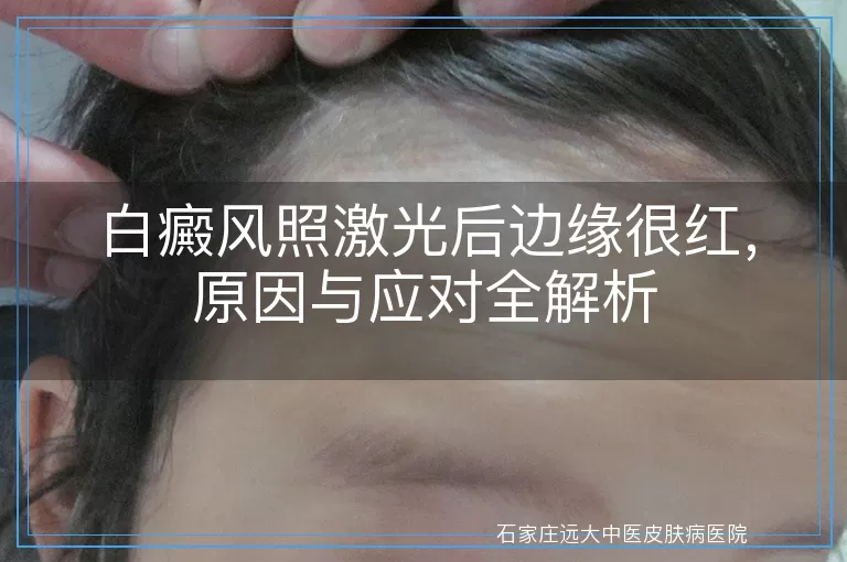 白癜风照激光后边缘很红，原因与应对全解析