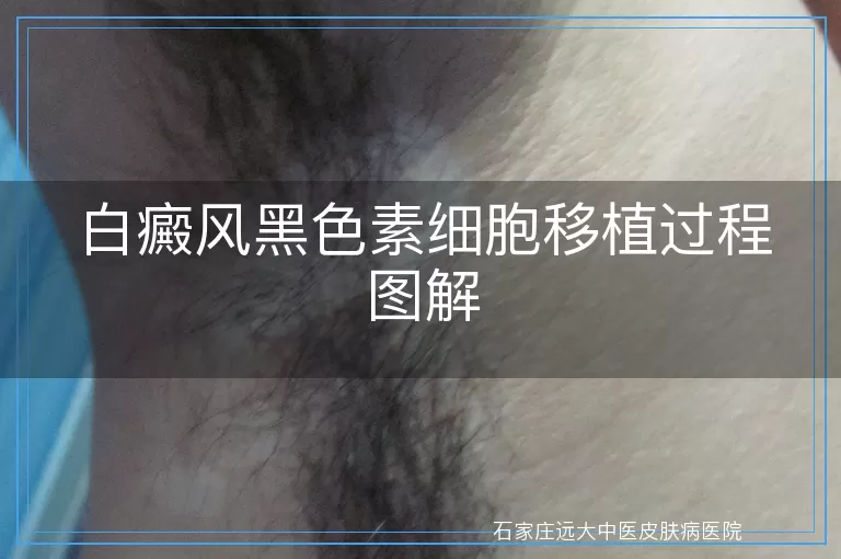 白癜风黑色素细胞移植过程图解