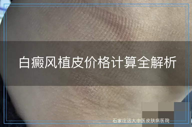 白癜风植皮价格计算全解析