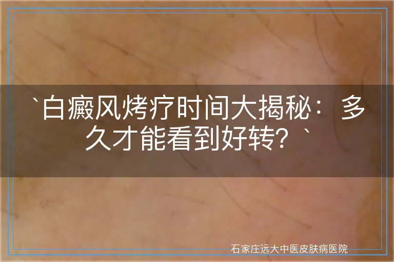 白癜风烤疗时间大揭秘：多久才能看到好转？