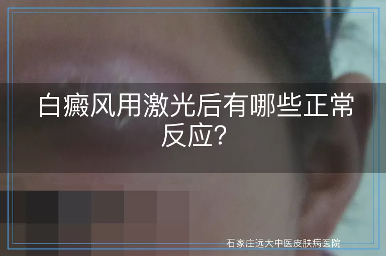 白癜风用激光后有哪些正常反应？