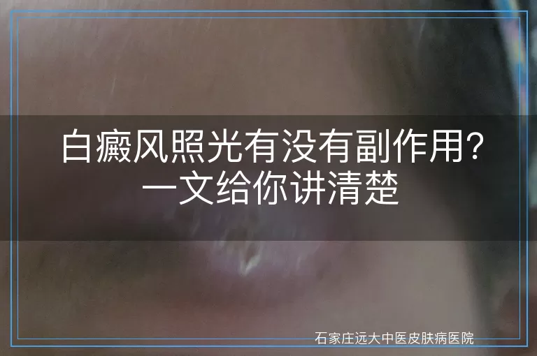 白癜风照光有没有副作用？一文给你讲清楚