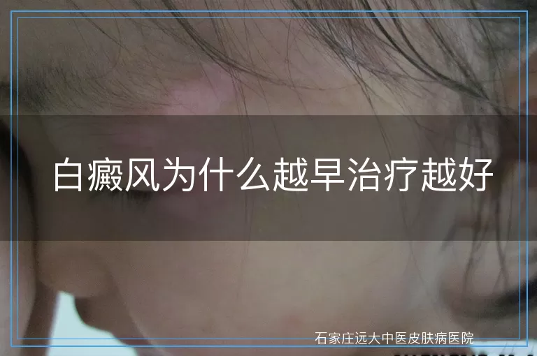 白癜风为什么越早治疗越好