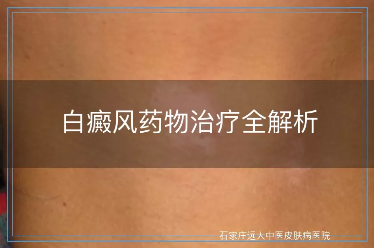 白癜风药物治疗全解析