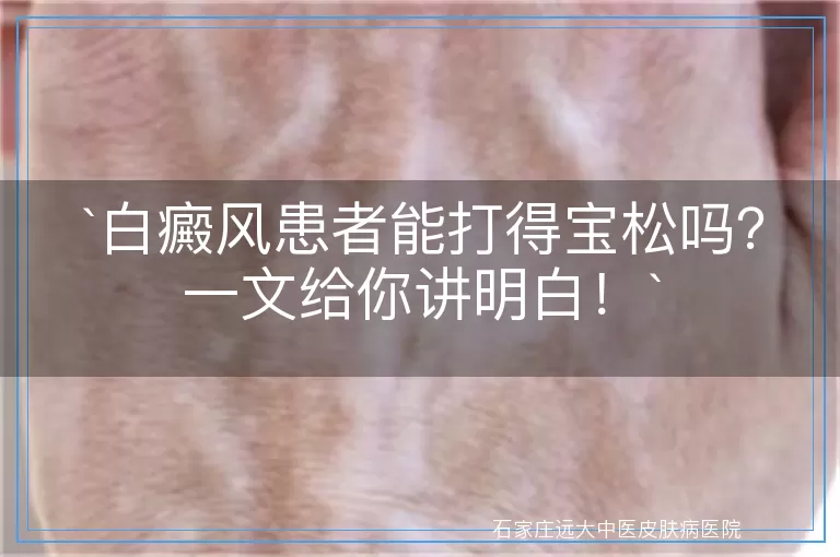 白癜风患者能打得宝松吗？一文给你讲明白！
