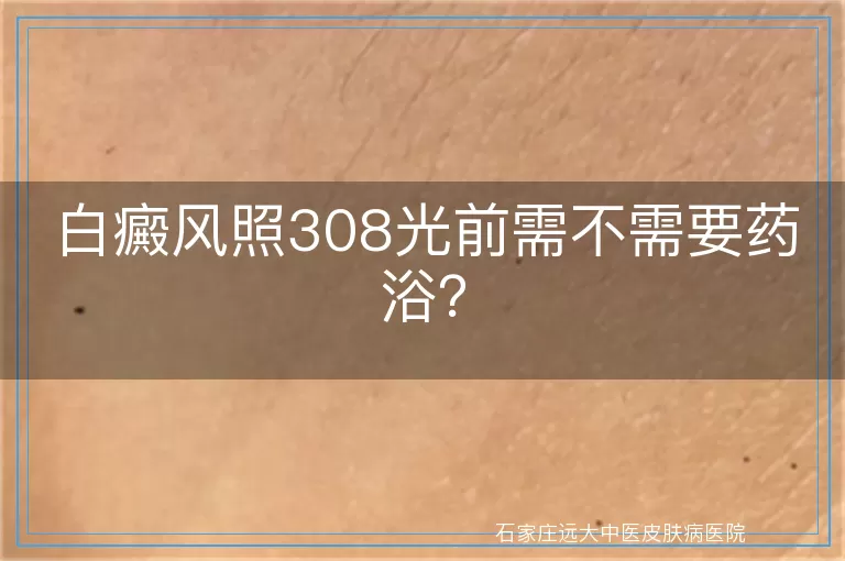 白癜风照308光前需不需要药浴？