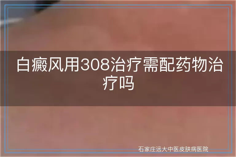 白癜风用308治疗需配药物治疗吗