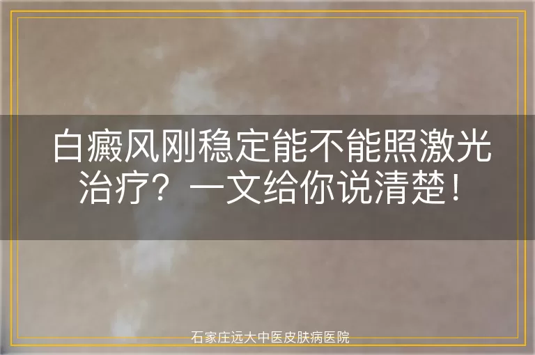 白癜风刚稳定能不能照激光治疗？一文给你说清楚！