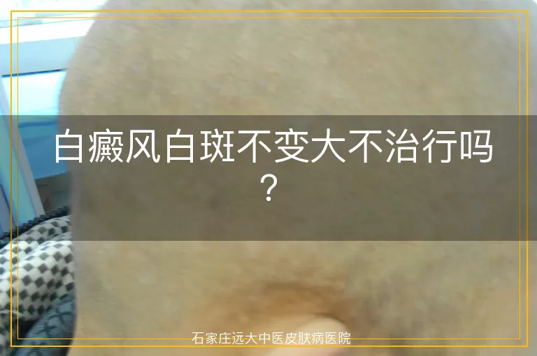 白癜风白斑不变大不治行吗？