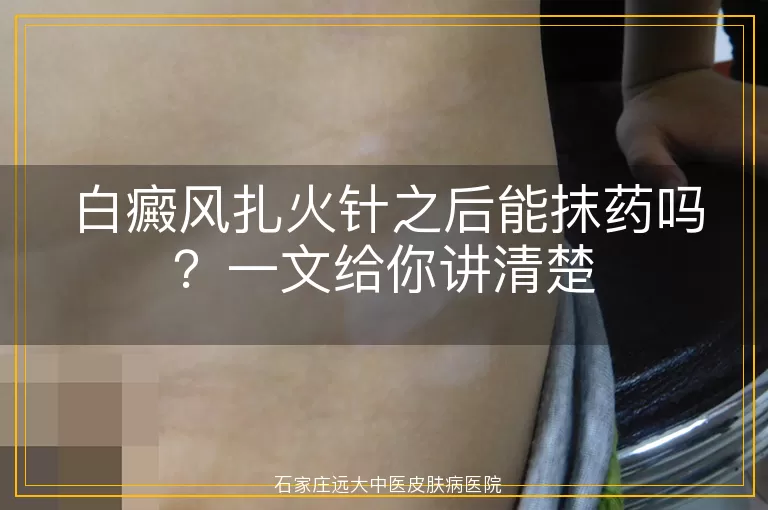 白癜风扎火针之后能抹药吗？一文给你讲清楚