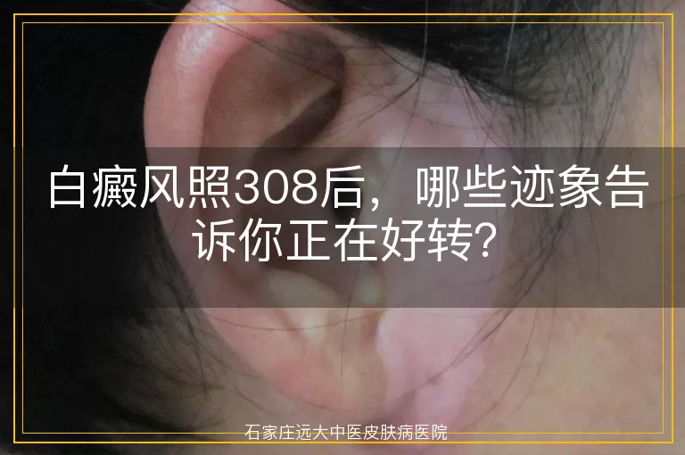 白癜风照308后，哪些迹象告诉你正在好转？