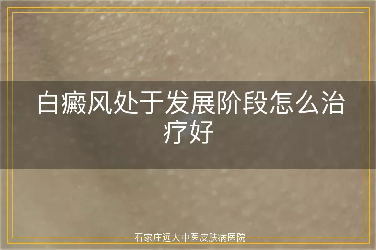 白癜风处于发展阶段怎么治疗好