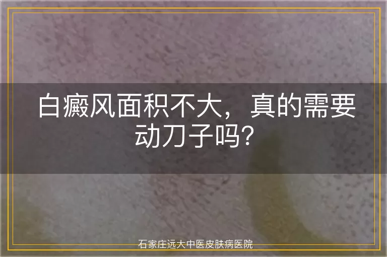 白癜风面积不大，真的需要动刀子吗？