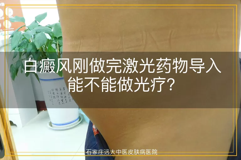 白癜风刚做完激光药物导入能不能做光疗？