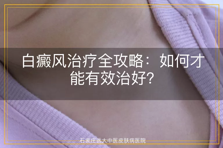 白癜风治疗全攻略：如何才能有效治好？