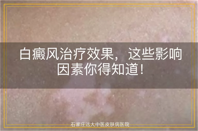 白癜风治疗效果，这些影响因素你得知道！