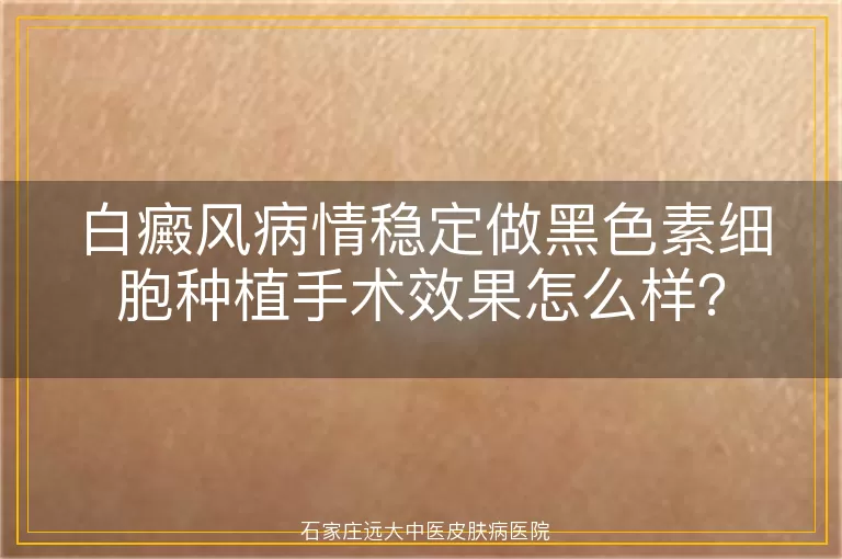 白癜风病情稳定做黑色素细胞种植手术效果怎么样？