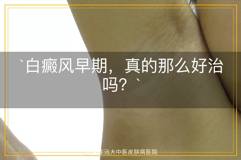白癜风早期，真的那么好治吗？