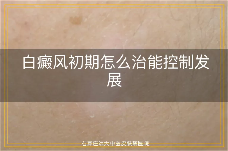白癜风初期怎么治能控制发展