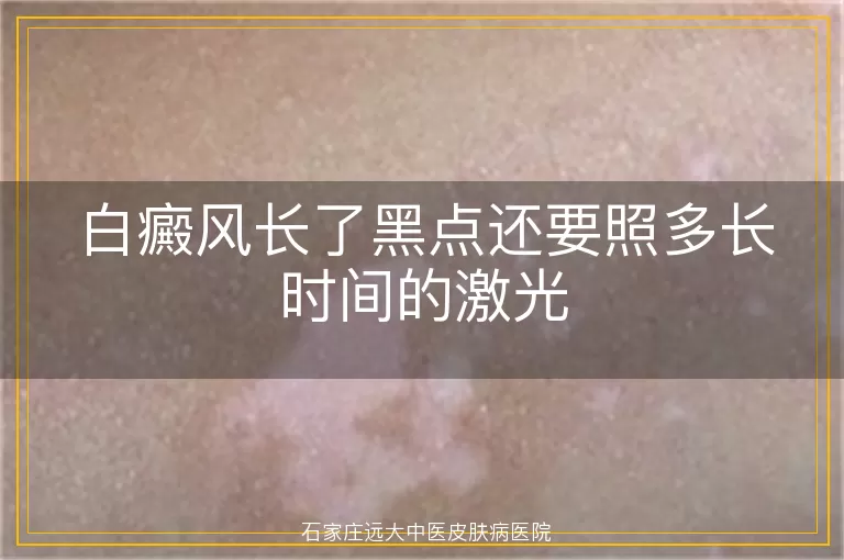 白癜风长了黑点还要照多长时间的激光