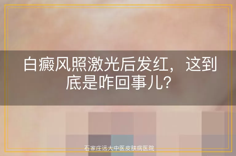 白癜风照激光后发红，这到底是咋回事儿？